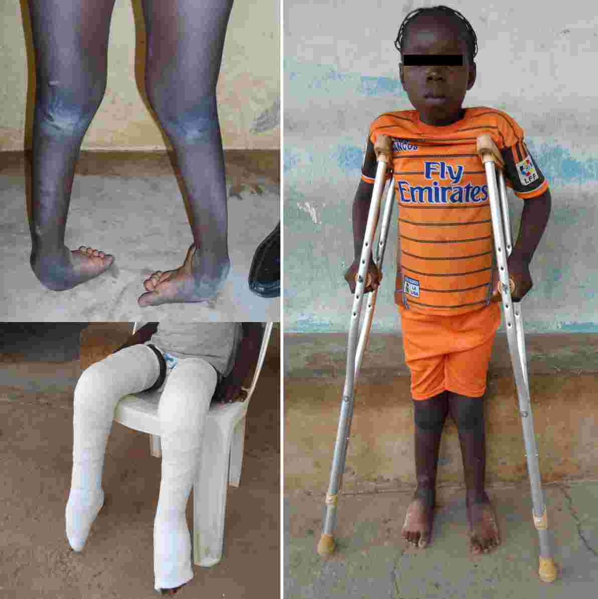 clubfoot_nkst_rehab